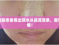 腭裂患者易出現(xiàn)水從鼻流現(xiàn)象，需警惕！