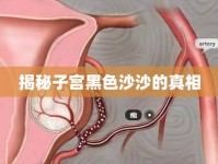 揭秘子宮黑色沙沙的真相