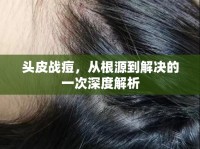 頭皮戰(zhàn)痘，從根源到解決的一次深度解析