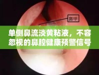 單側(cè)鼻流淡黃粘液，不容忽視的鼻腔健康預(yù)警信號(hào)