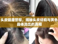 頭皮健康警報(bào)，揭秘頭皮結(jié)痂與黃色晶體流出的真相