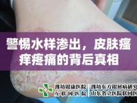 警惕水樣滲出，皮膚瘙癢疼痛的背后真相