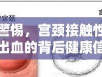 警惕，宮頸接觸性出血的背后健康信號(hào)與應(yīng)對(duì)策略