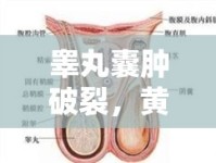 睪丸囊腫破裂，黃膿水背后的健康警鐘