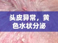 頭皮異常，黃色水狀分泌物與惡臭的警鐘