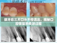拔牙后三天口水不停流出，揭秘口腔恢復(fù)的奇妙過程