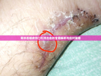 骨折后植皮傷口引流出血的全面解析與應(yīng)對策略