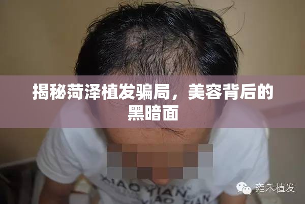 揭秘菏澤植發(fā)騙局，美容背后的黑暗面