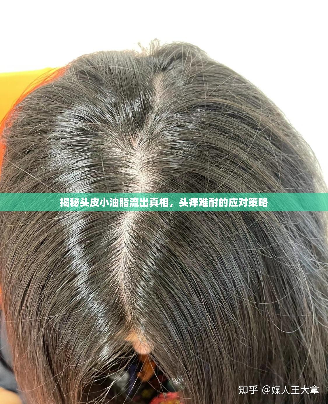 揭秘頭皮小油脂流出真相，頭癢難耐的應對策略