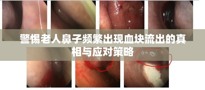 警惕老人鼻子頻繁出現(xiàn)血塊流出的真相與應(yīng)對(duì)策略
