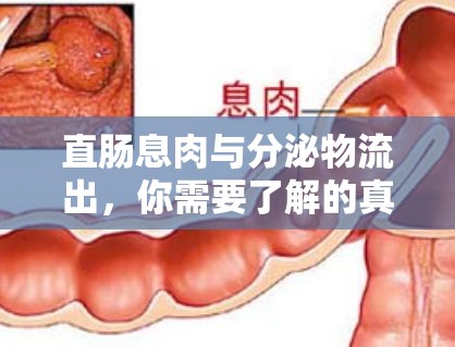 直腸息肉與分泌物流出，你需要了解的真相