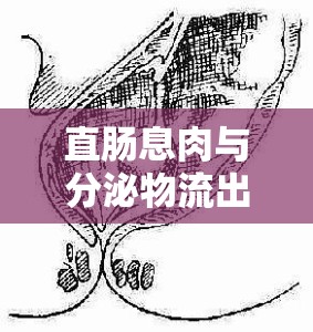 直腸息肉與分泌物流出，你需要了解的真相