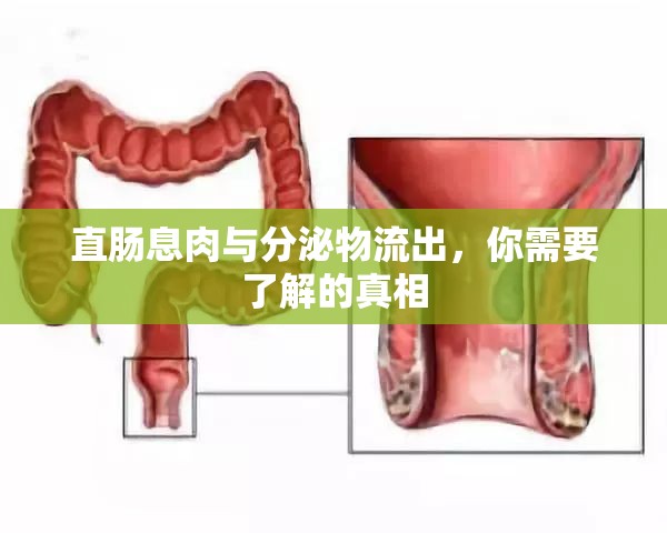 直腸息肉與分泌物流出，你需要了解的真相