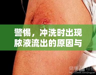 警惕，沖洗時出現(xiàn)膿液流出的原因與應(yīng)對策略