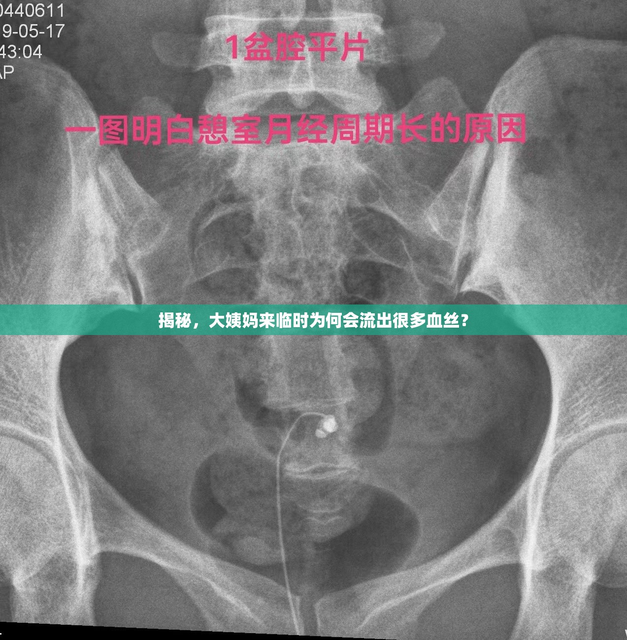揭秘，大姨媽來臨時為何會流出很多血絲？