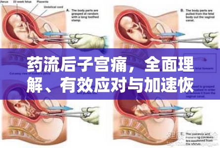 藥流后子宮痛，全面理解、有效應對與加速恢復指南