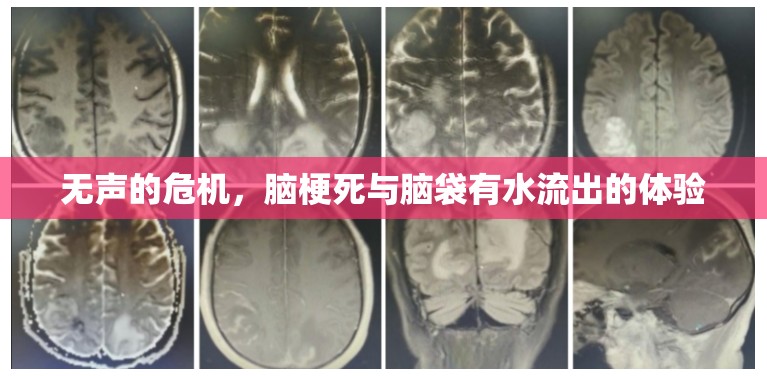 無(wú)聲的危機(jī)，腦梗死與腦袋有水流出的體驗(yàn)