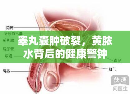 睪丸囊腫破裂，黃膿水背后的健康警鐘