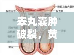 睪丸囊腫破裂，黃膿水背后的健康警鐘