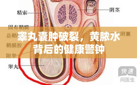 睪丸囊腫破裂，黃膿水背后的健康警鐘