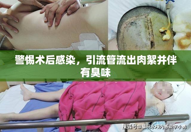 警惕術(shù)后感染，引流管流出肉絮并伴有臭味