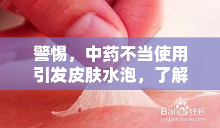 警惕，中藥不當(dāng)使用引發(fā)皮膚水泡，了解真相與應(yīng)對措施