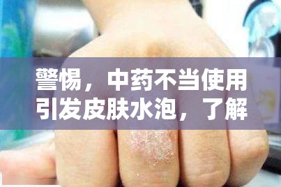警惕，中藥不當(dāng)使用引發(fā)皮膚水泡，了解真相與應(yīng)對措施