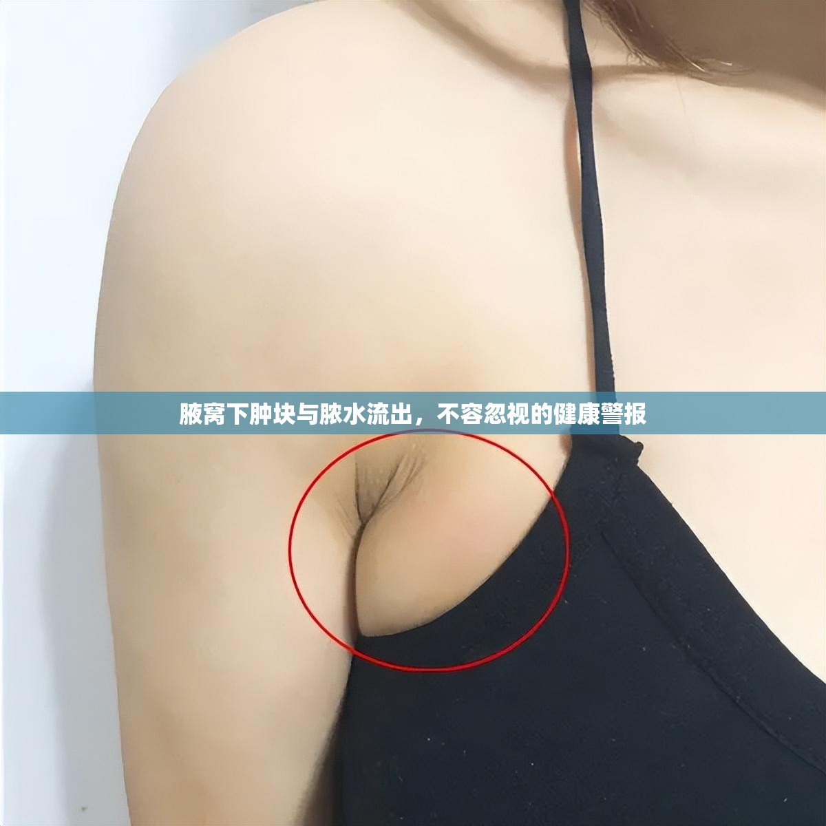 腋窩下腫塊與膿水流出，不容忽視的健康警報(bào)