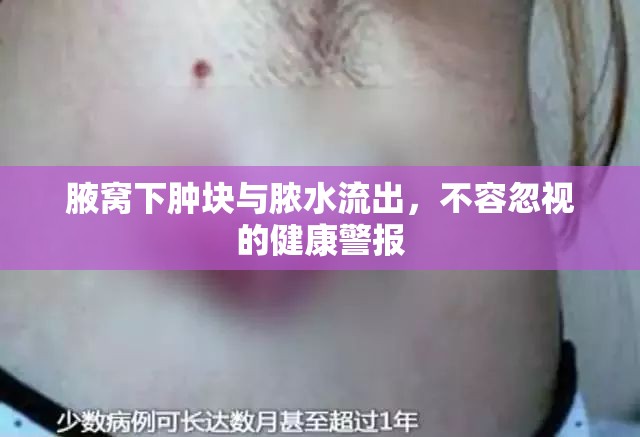 腋窩下腫塊與膿水流出，不容忽視的健康警報(bào)