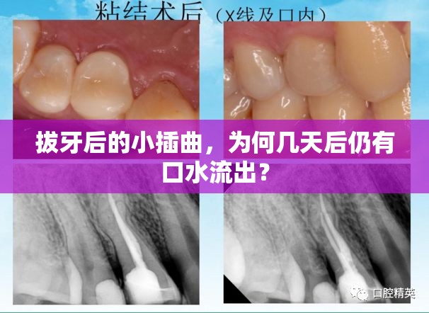 拔牙后的小插曲，為何幾天后仍有口水流出？