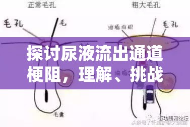 探討尿液流出通道梗阻，理解、挑戰(zhàn)與治療策略