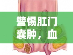 警惕肛門(mén)囊腫，血流出時(shí)，你需要了解的健康警報(bào)