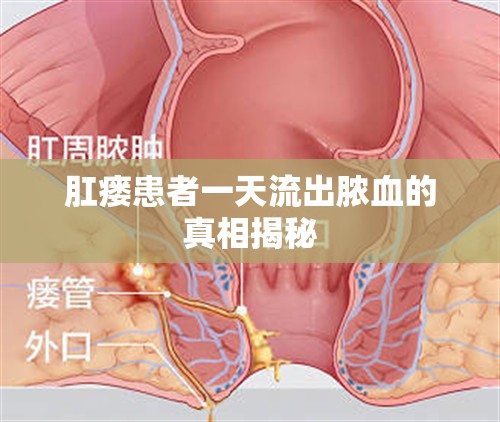 肛瘺患者一天流出膿血的真相揭秘