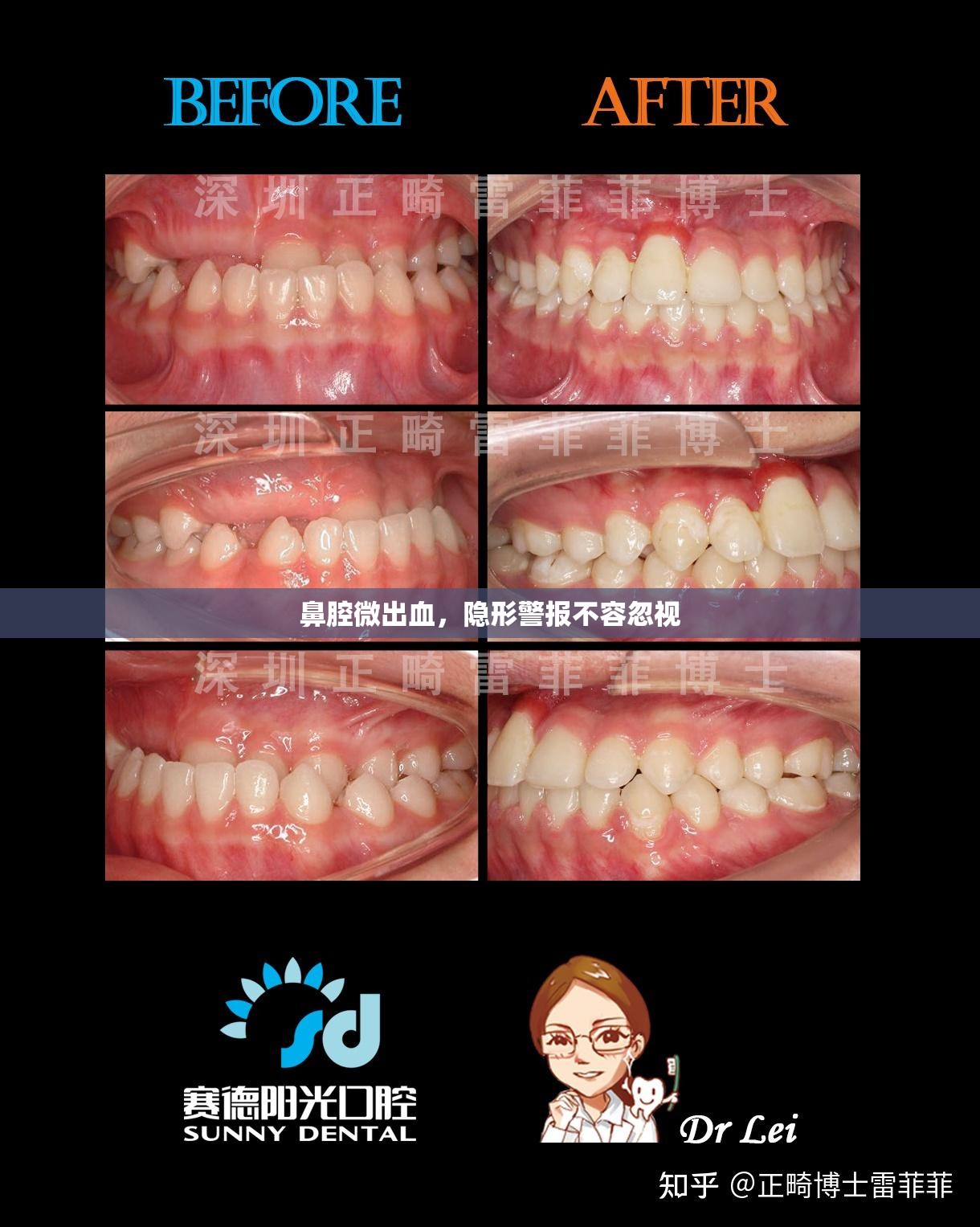 鼻腔微出血，隱形警報不容忽視