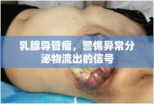 乳腺導(dǎo)管瘤，警惕異常分泌物流出的信號
