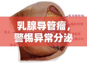 乳腺導(dǎo)管瘤，警惕異常分泌物流出的信號