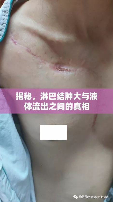 揭秘，淋巴結(jié)腫大與液體流出之間的真相