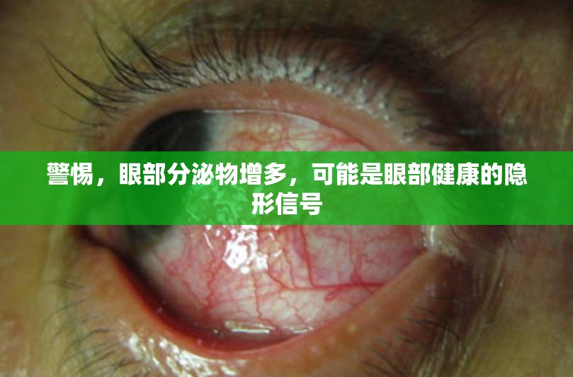 警惕，眼部分泌物增多，可能是眼部健康的隱形信號(hào)
