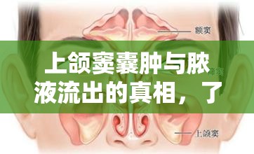 上頜竇囊腫與膿液流出的真相，了解、預(yù)防與治療