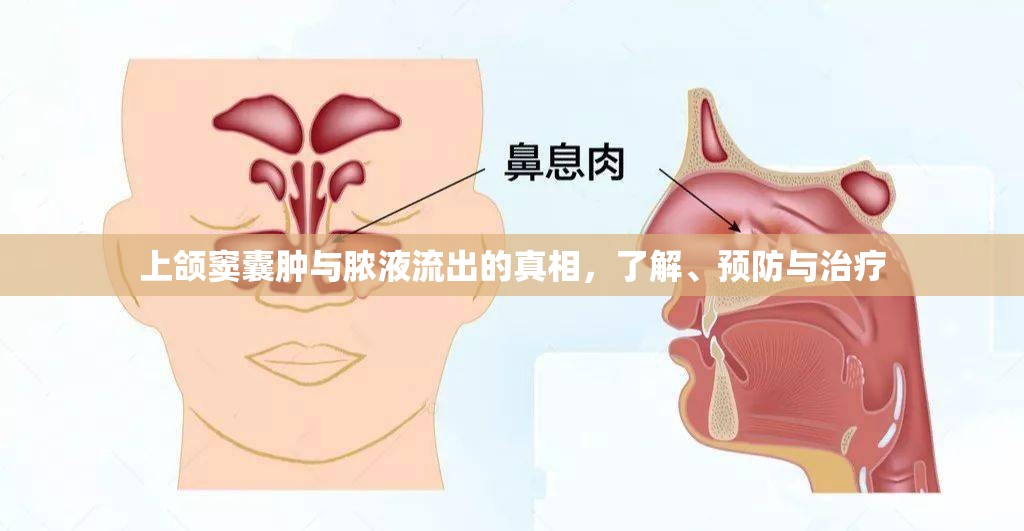 上頜竇囊腫與膿液流出的真相，了解、預(yù)防與治療
