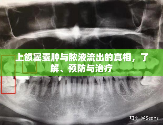 上頜竇囊腫與膿液流出的真相，了解、預(yù)防與治療