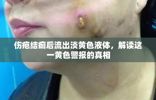 傷疤結(jié)痂后流出淡黃色液體，解讀這一黃色警報(bào)的真相