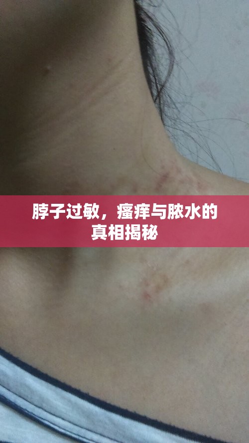 脖子過敏，瘙癢與膿水的真相揭秘