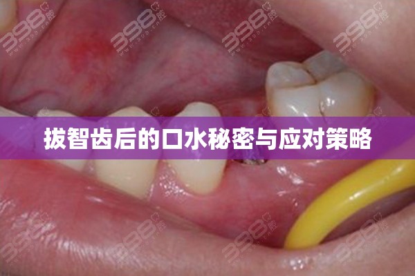 拔智齒后的口水秘密與應(yīng)對策略