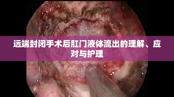 遠(yuǎn)端封閉手術(shù)后肛門液體流出的理解、應(yīng)對與護(hù)理
