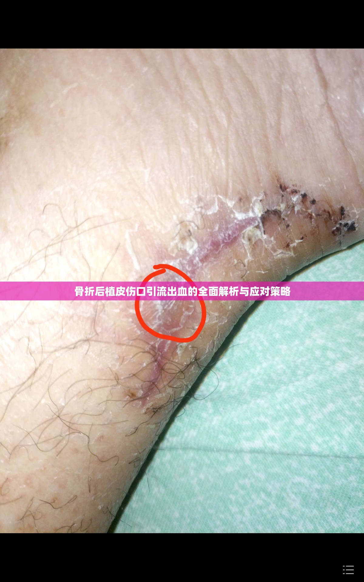 骨折后植皮傷口引流出血的全面解析與應對策略