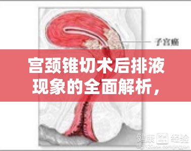 宮頸錐切術(shù)后排液現(xiàn)象的全面解析，了解、應(yīng)對(duì)與護(hù)理指南