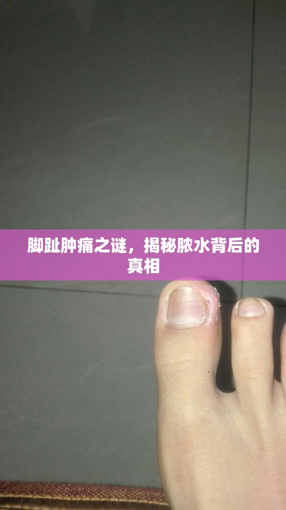 腳趾腫痛之謎，揭秘膿水背后的真相