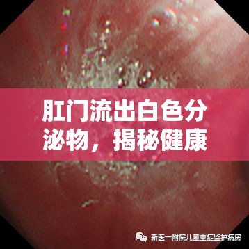 肛門流出白色分泌物，揭秘健康警報的真相