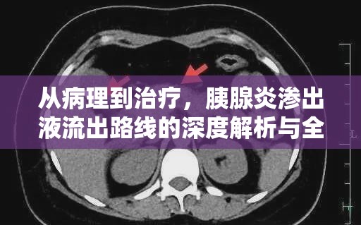 從病理到治療，胰腺炎滲出液流出路線的深度解析與全程探索